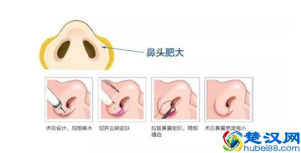 鼻翼缩小，让你的五官立起来