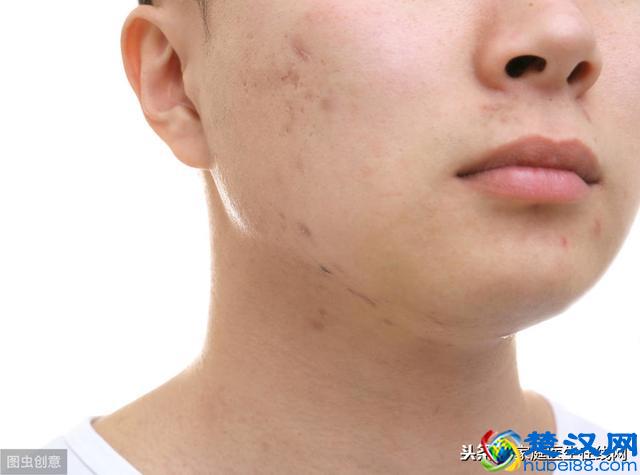 毛孔粗大如何改善？先把6个“根源”解决掉，毛孔才会慢慢缩小