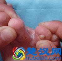 冬天宜治香港脚？没错！这样做断根不复发！