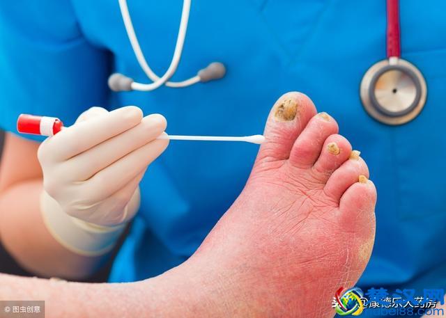 灰指甲，药用对了吗