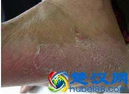 冬天宜治香港脚？没错！这样做断根不复发！