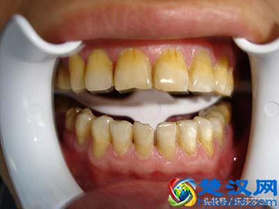 史上最全牙齿美白方法，没有之一！