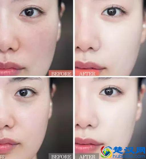 脸上有很多雀斑、痘印，一直去不掉怎么办？