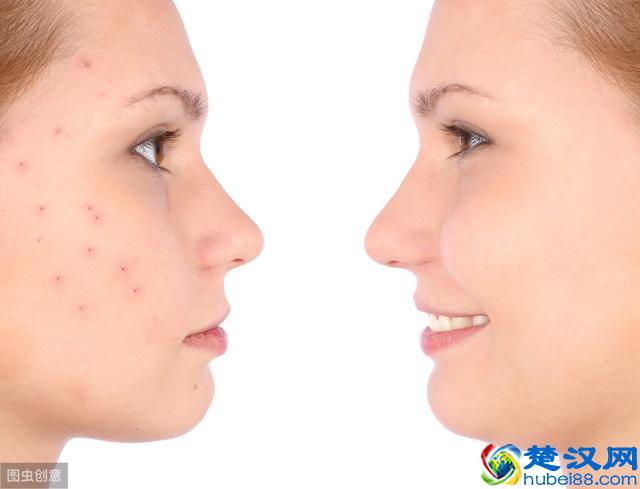 如何让红色痘印、黑色痘印消失地快点｜三大要点请记住