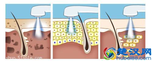 如何让红色痘印、黑色痘印消失地快点｜三大要点请记住