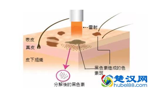 如何让红色痘印、黑色痘印消失地快点｜三大要点请记住