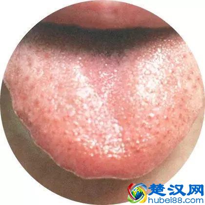 治疗肝硬化，你用对了药吗？最全治疗肝硬化中成药！