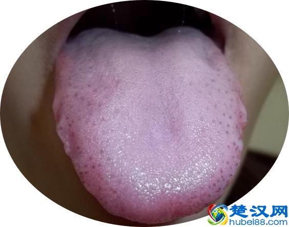 治疗肝硬化，你用对了药吗？最全治疗肝硬化中成药！