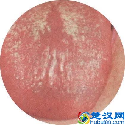 治疗肝硬化，你用对了药吗？最全治疗肝硬化中成药！