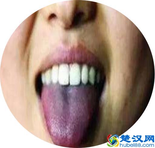 治疗肝硬化，你用对了药吗？最全治疗肝硬化中成药！