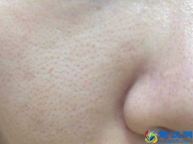 简单三招，拯救你的毛孔粗大，让你毛孔细到看不出