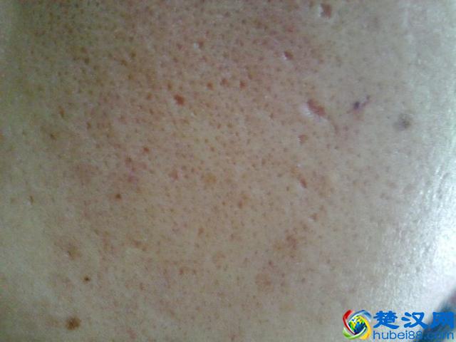 简单三招，拯救你的毛孔粗大，让你毛孔细到看不出