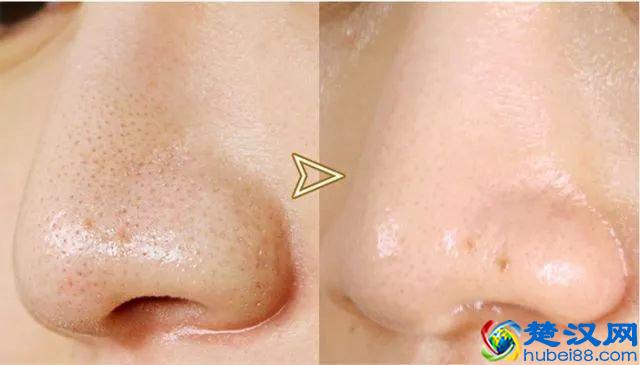 简单三招，拯救你的毛孔粗大，让你毛孔细到看不出