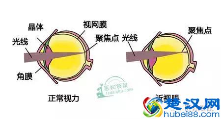 揭底“近视治疗仪”，“神器”还是坑娃？