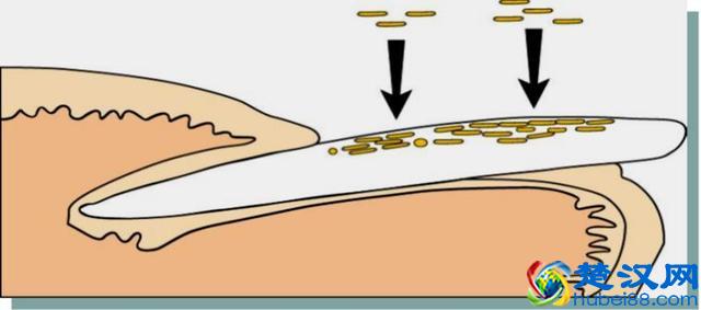 “得了灰指甲，一个传染俩”？别害怕！最正规的治疗指南来了