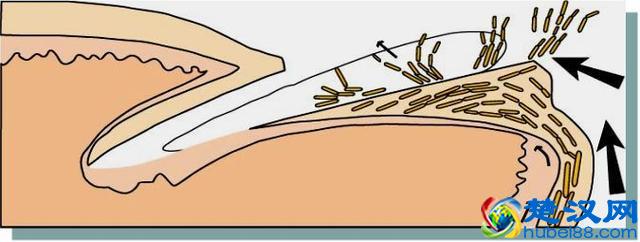 “得了灰指甲，一个传染俩”？别害怕！最正规的治疗指南来了