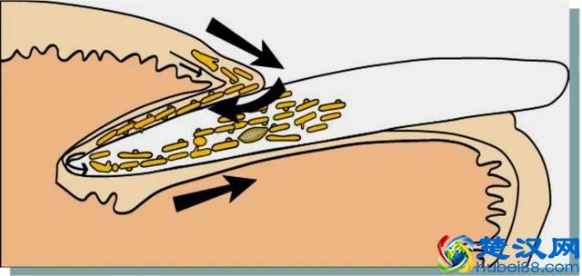 “得了灰指甲，一个传染俩”？别害怕！最正规的治疗指南来了