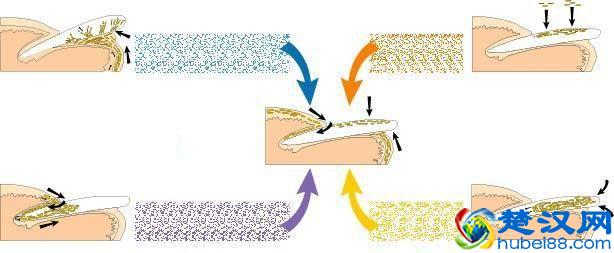 “得了灰指甲，一个传染俩”？别害怕！最正规的治疗指南来了
