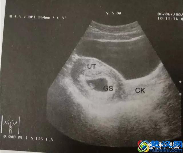 胎囊、胎芽、胎心到底是什么？