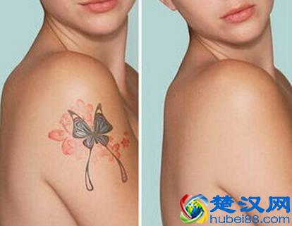 洗纹身需要多少钱