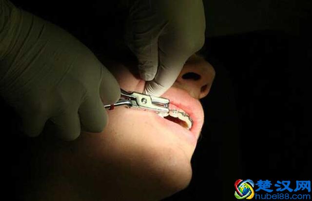 拔牙价格多少钱一颗 哪些情况要拔牙