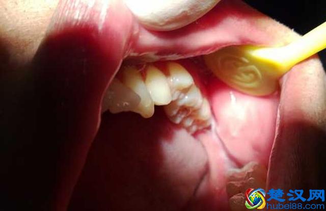 拔牙价格多少钱一颗 哪些情况要拔牙