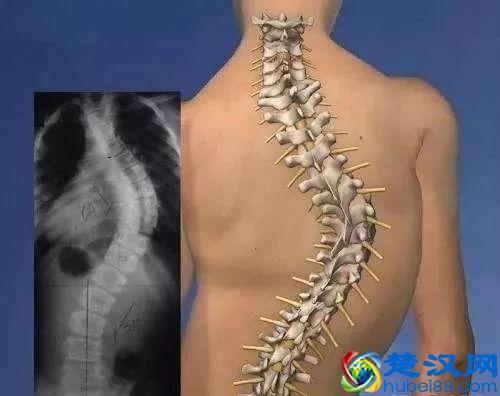 郝大夫，穿背背佳能纠正孩子驼背吗？