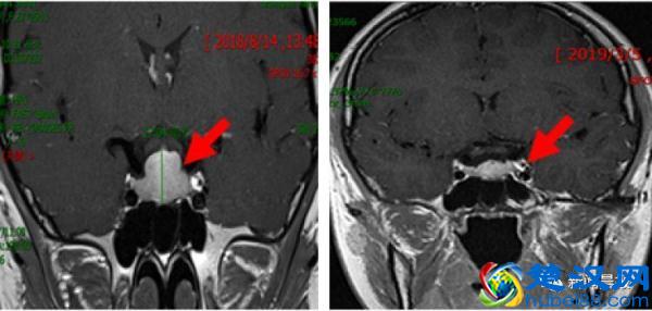 19岁女孩身高仅1米48！停长几年后突然开始长高了！