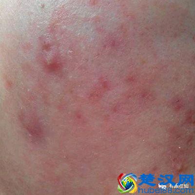 如何消除红色痘印