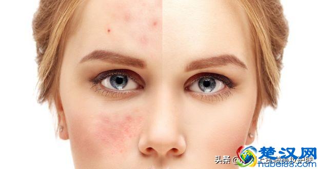 什么是皮肤屏障？皮肤屏障受损，怎么破？