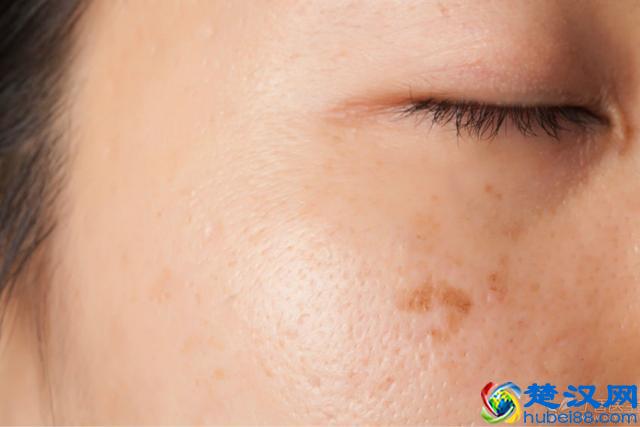 毛孔粗大怎么办？皮肤科医生给你出几招