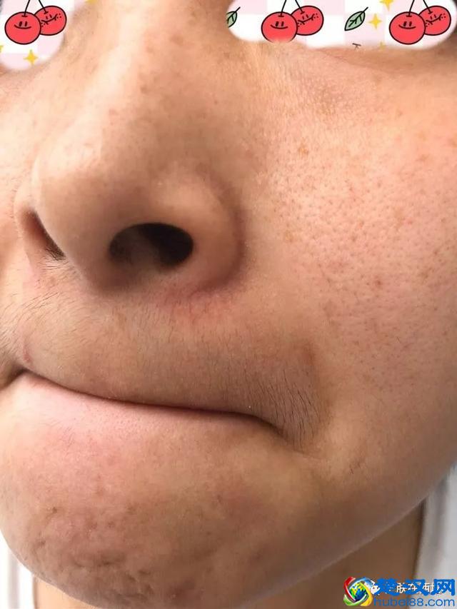 泛滥的玫瑰痤疮