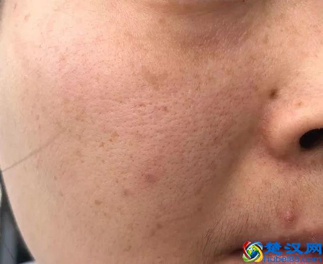 泛滥的玫瑰痤疮