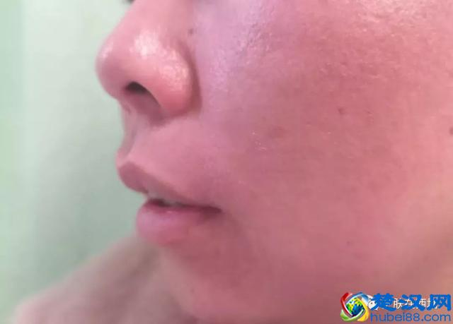 泛滥的玫瑰痤疮