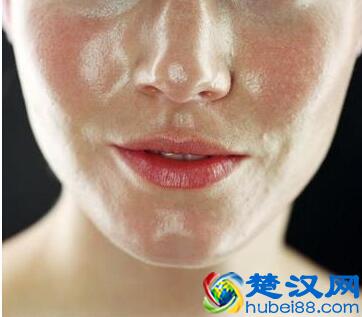 鼻子出血如何进行紧急处理