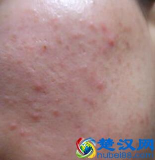 脸上的痘痘到底是什么原因造成的，怎么解决？