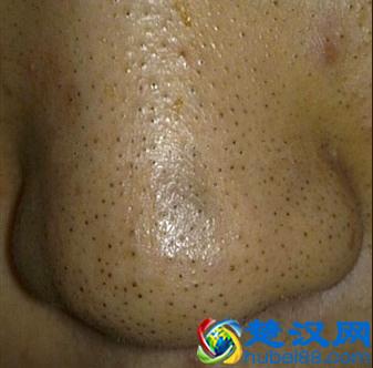 黑头的成因和解决方法