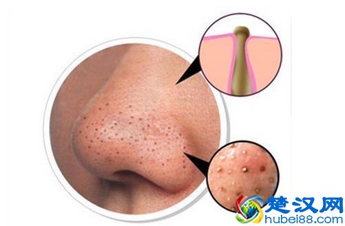 黑头的成因和解决方法