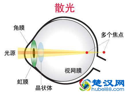 什么是散光？和正常眼睛相比，看东西有什么不同？