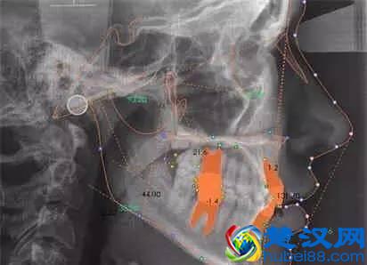 牙齿矫正到底要多少钱？