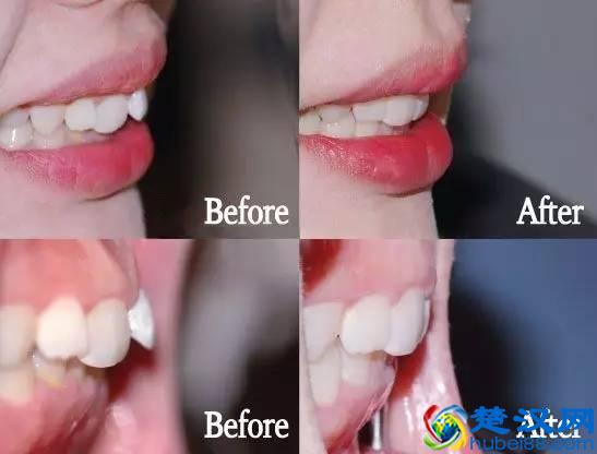 牙齿矫正到底要多少钱？