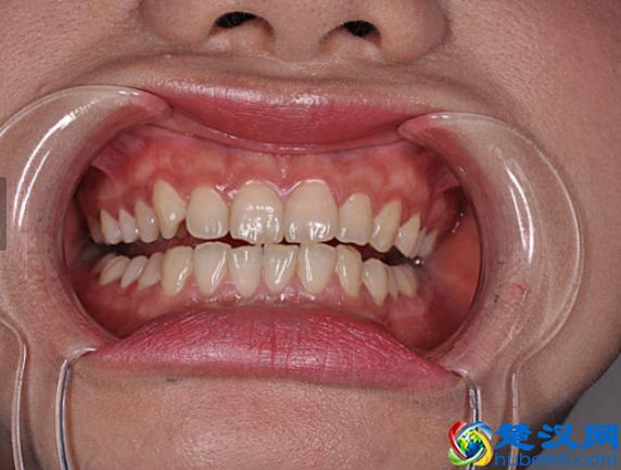 牙疼怎么办，教你几个立刻止疼妙绝招