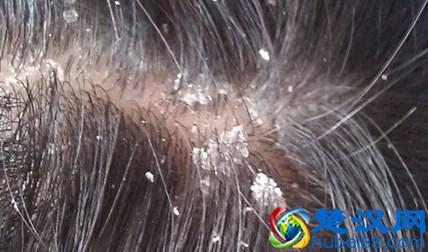 要崩溃，头皮屑这么多是什么原因啊？每天洗头也不行