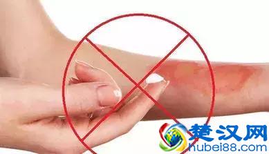 烫伤后怎么处理才最正确？抹酱油？涂牙膏？答案颠覆你所有观念