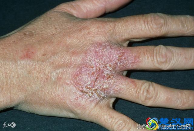 秋季湿疹加重用什么药好？真正靠谱的就这4个方法