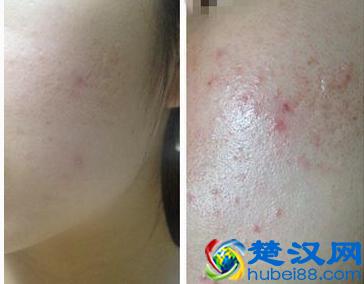 下巴老是长痘痘怎么回事？教你从源头祛痘！