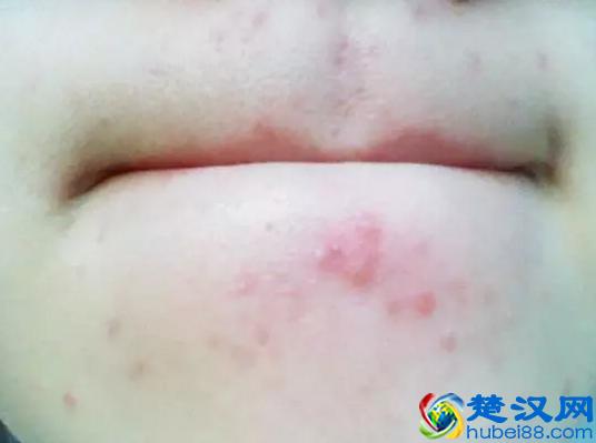 下巴老是长痘痘怎么回事？教你从源头祛痘！