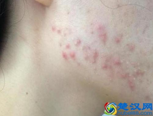 下巴老是长痘痘怎么回事？教你从源头祛痘！