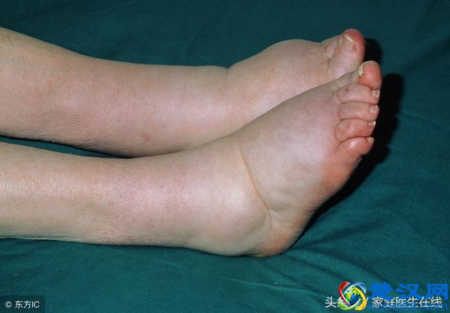 祛除体内湿气，建议吃这3种食物，便宜又好吃