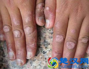 请注意红斑狼疮的早期症状，及时治疗